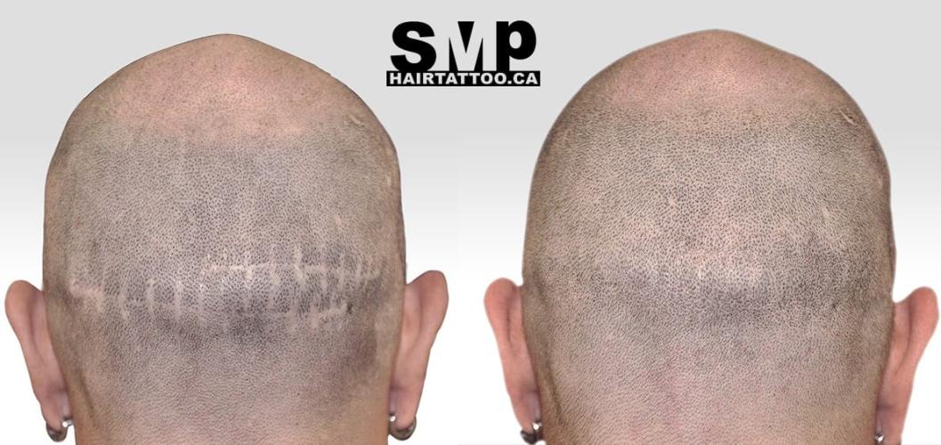 HAIRTATTOO.CA | SMP Scalp Micropigmentation Toronto